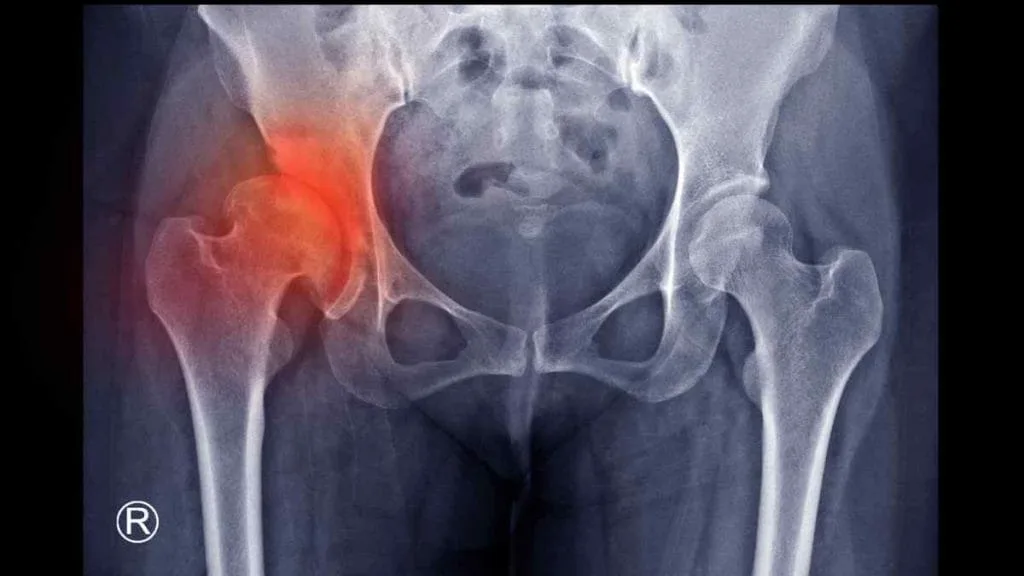 Radiografia da bacia com a articulação do quadril marcada em vermelho